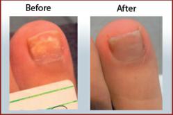 Toenail fungus laser treatment results
